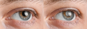 Before And After Glaucoma Surgery symptoms
